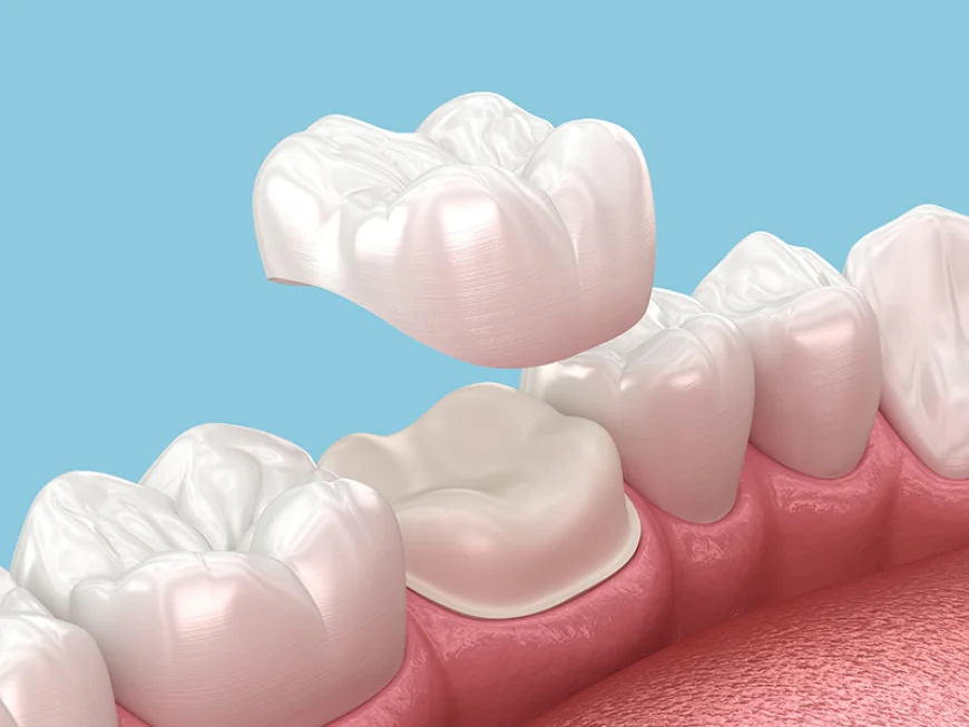 Dental Crowns and Bridges Dubai – Durable & Natural-Looking Solutions