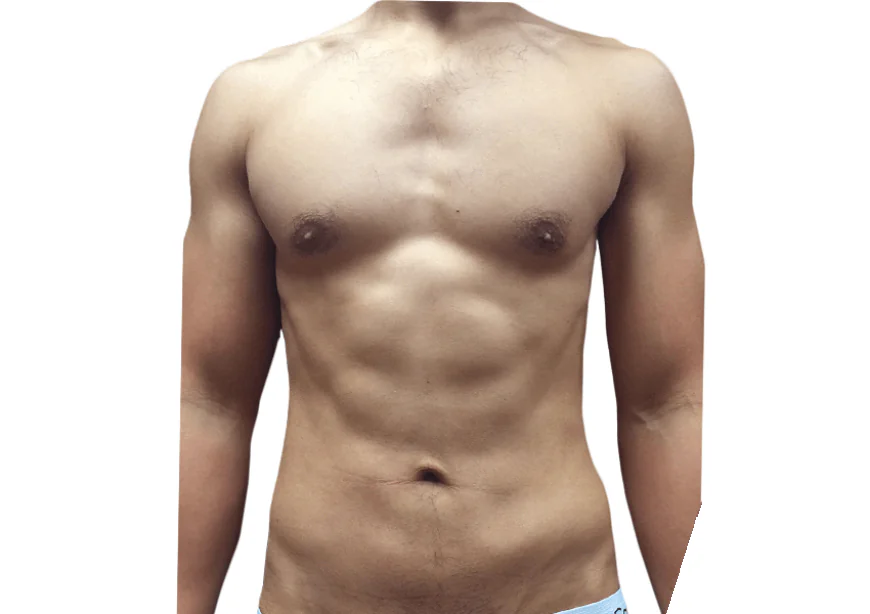 What Is the Recovery Process After Liposuction?