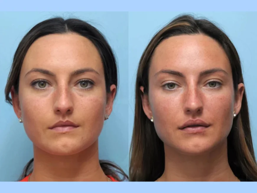 Enhance Facial Contours with the Best Plastic Surgeon in Dubai for Thread Lift