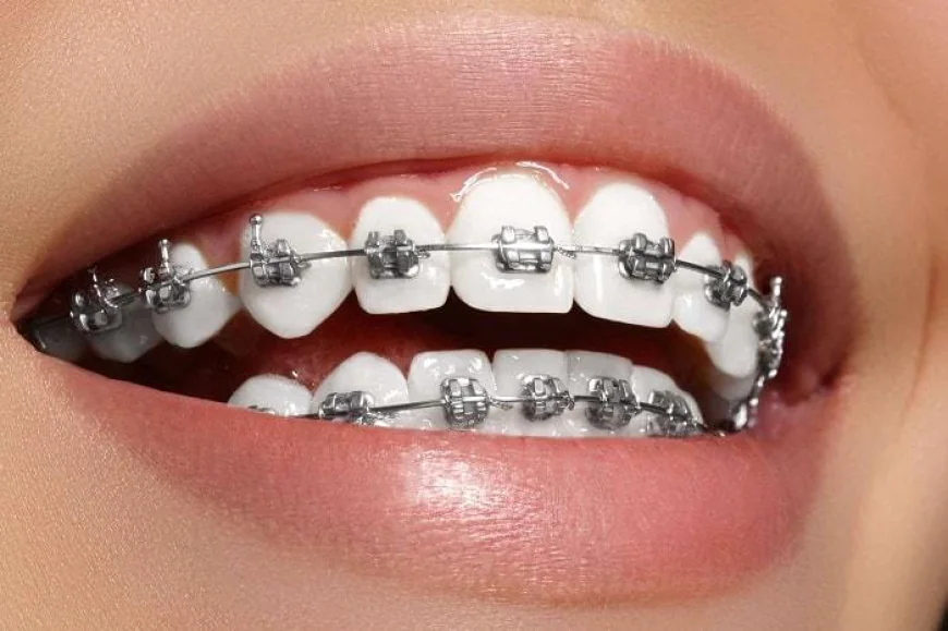 Can braces cause tooth decay or gum issues?