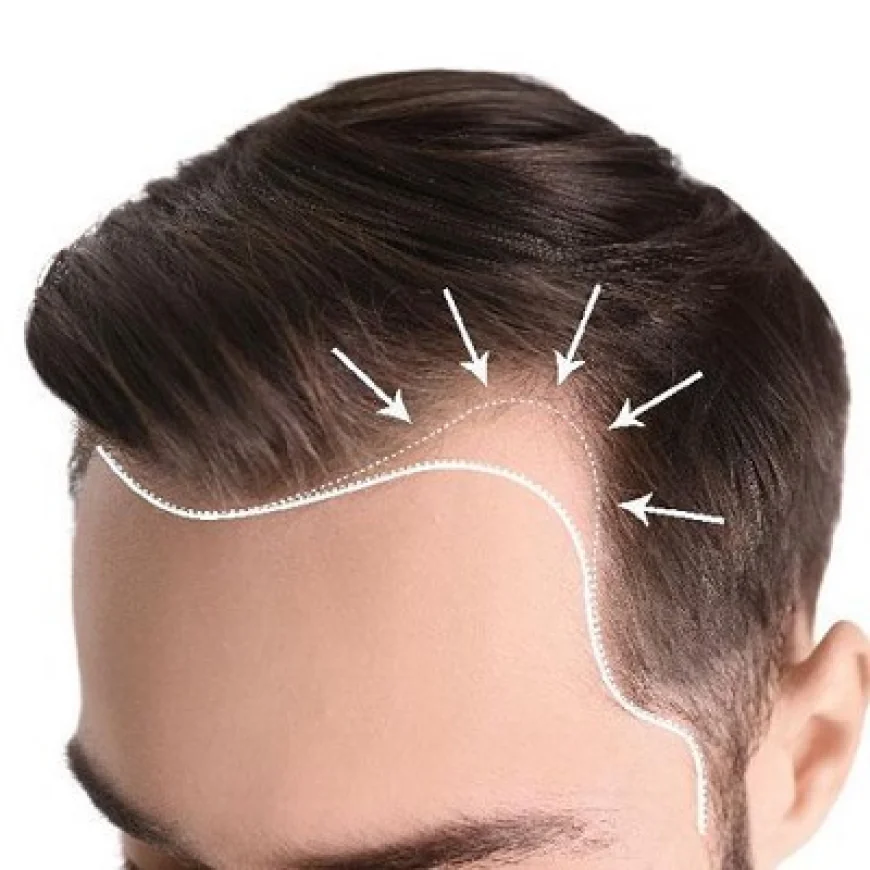 Hair Transplant Recovery Timeline: Month by Month
