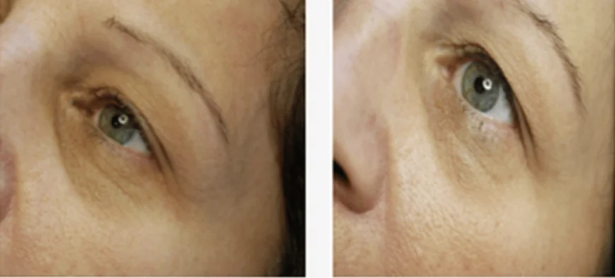 جلسات سبا للبشرة المتعبة والهالات السوداء