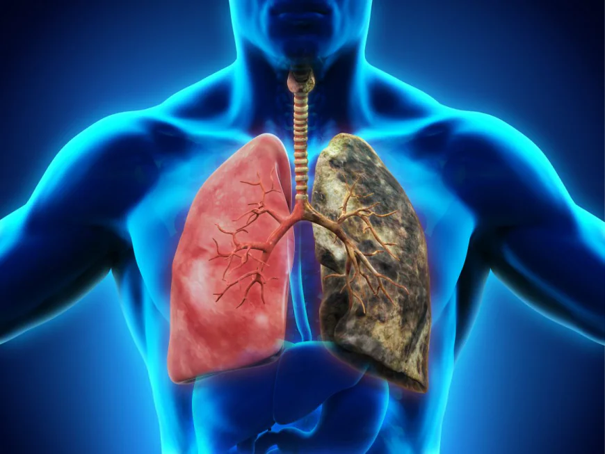 Small Cell Lung Cancer Treatment: Common Side Effects and How to Cope