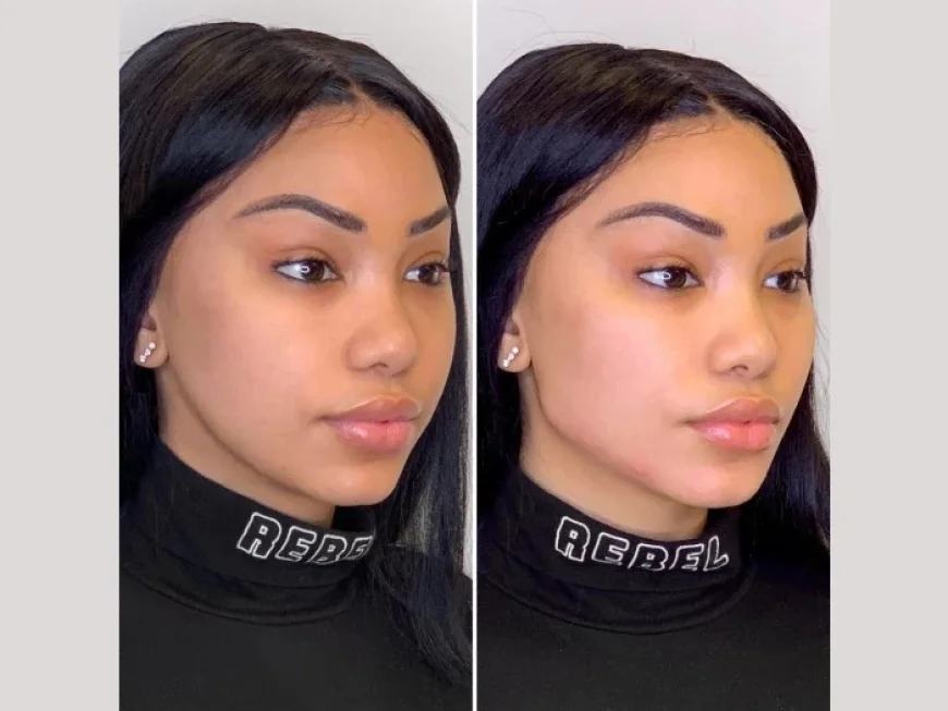 Best Aesthetic Clinic in Dubai Enhances Natural Beauty Through Thread Lift