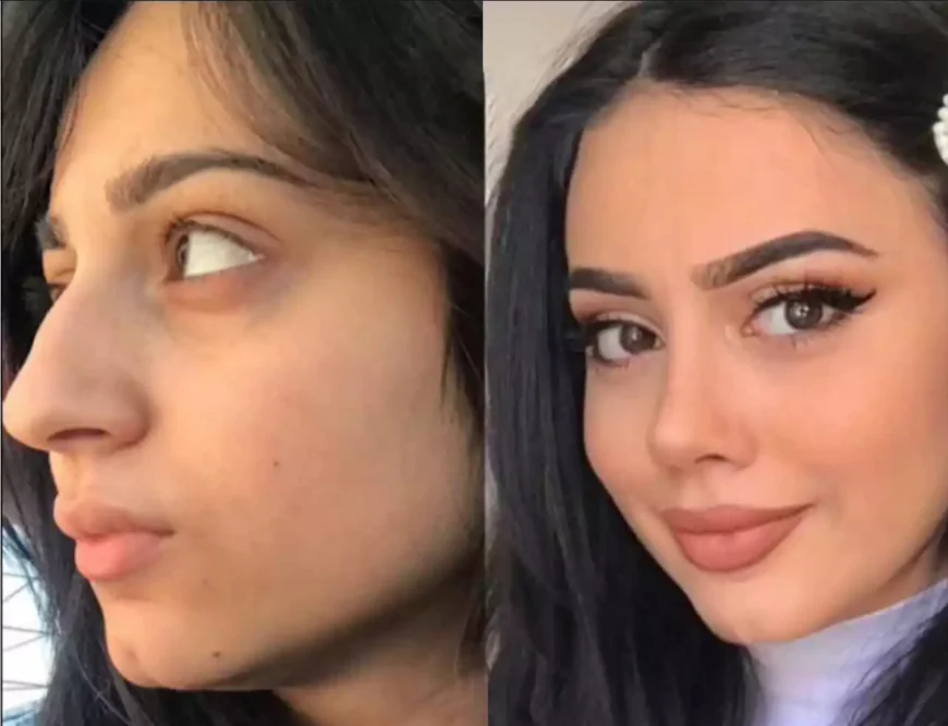 Best Rhinoplasty Surgeon in Dubai for Subtle Enhancements