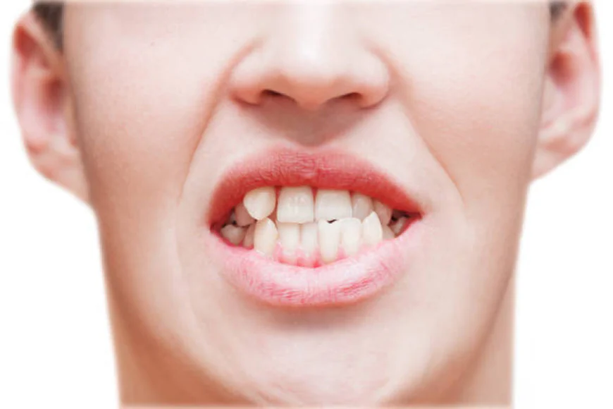 What is Crowded Teeth Treatment and How it works?