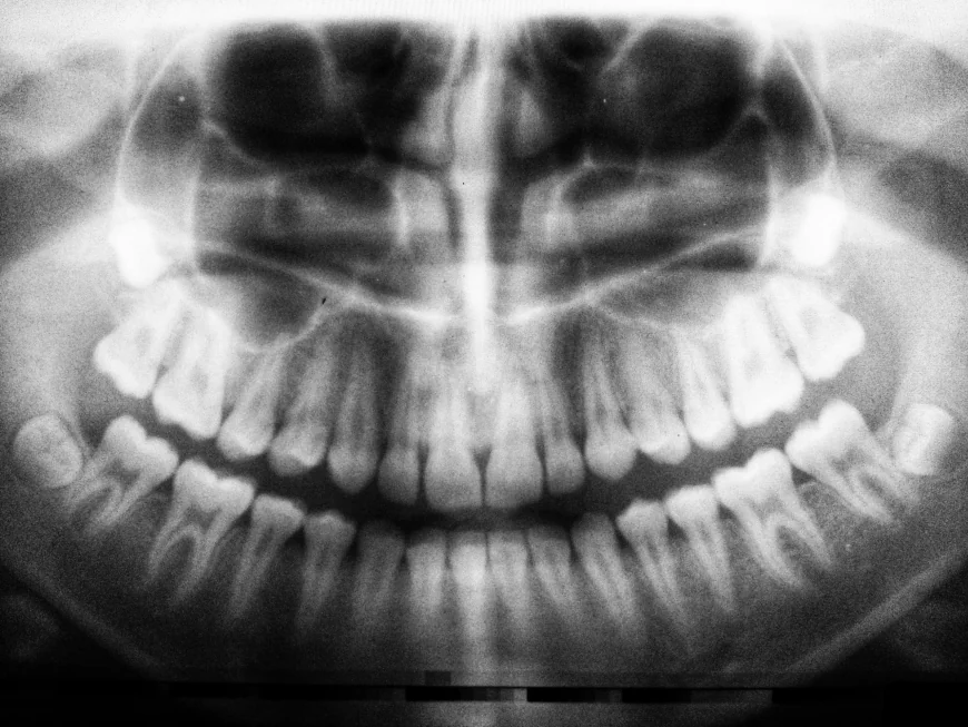 What to Expect From a Panoramic Dental X-Ray Cost Visit