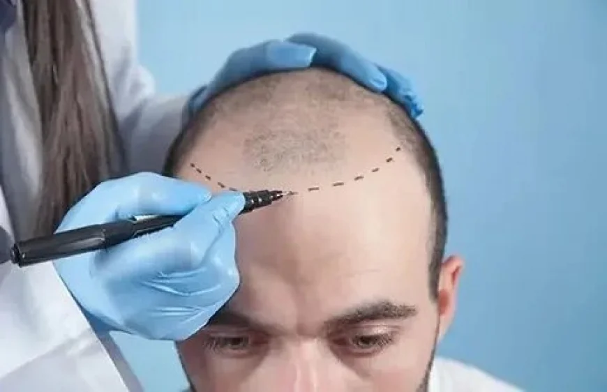 Transform Your Look: The Ultimate Guide to Hair Transplant in Islamabad