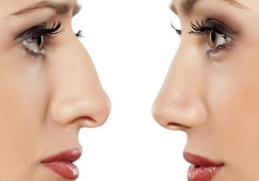 Nose Bridge Augmentation in Riyadh