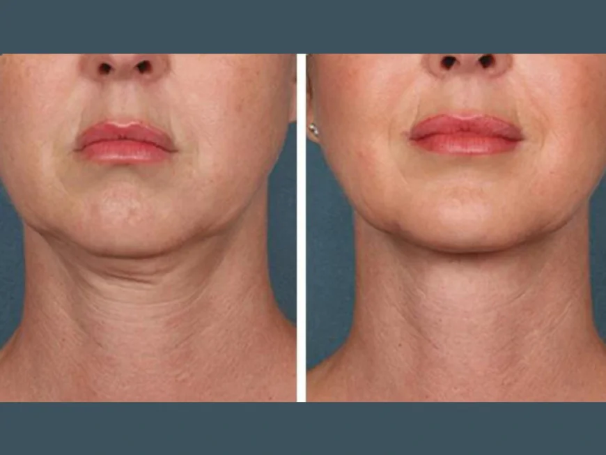 Best Aesthetic Clinics in dubai for PRP Injections for Youthful Glow