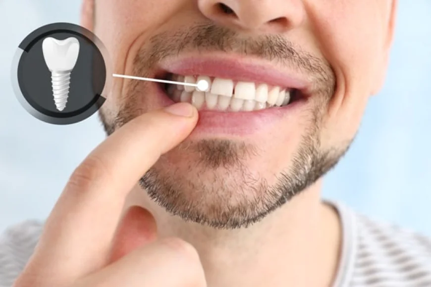 Caring for Your Gums After Dental Implant Surgery