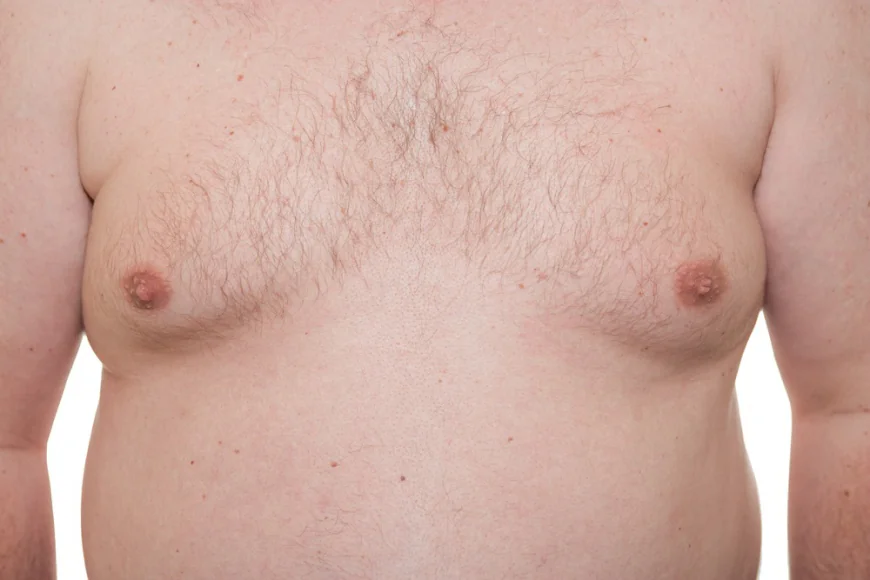 Why Choose Gynecomastia in Dubai?