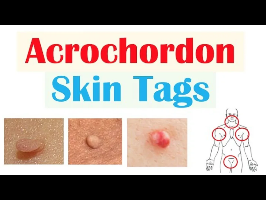 Learn the correct ICD 10 for acrochordon in medical coding