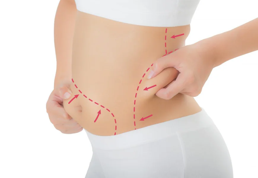 Revolutionary Laser Liposuction Riyadh