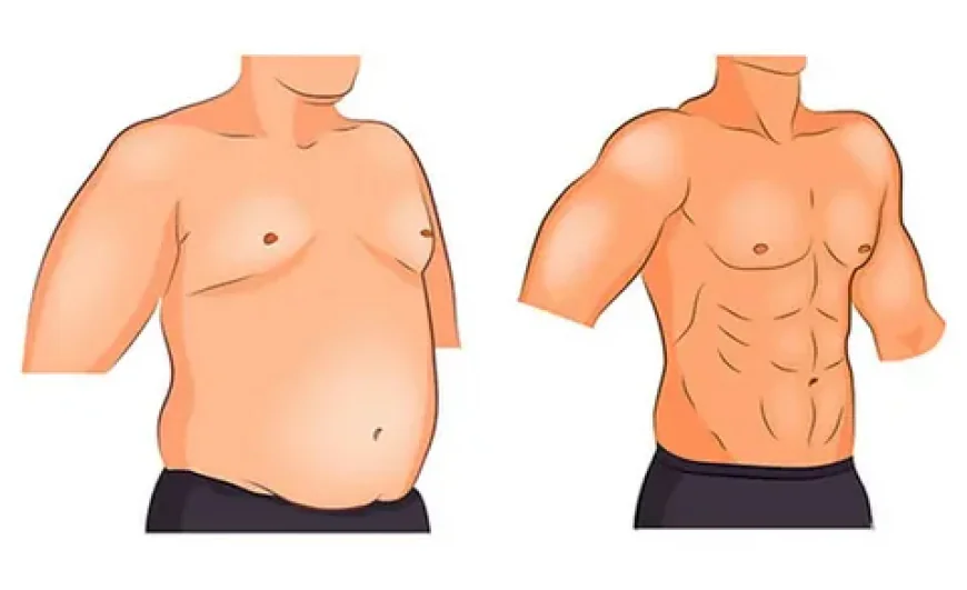 Gynecomastia in Islamabad – A Modern Solution for Male Breast Reduction