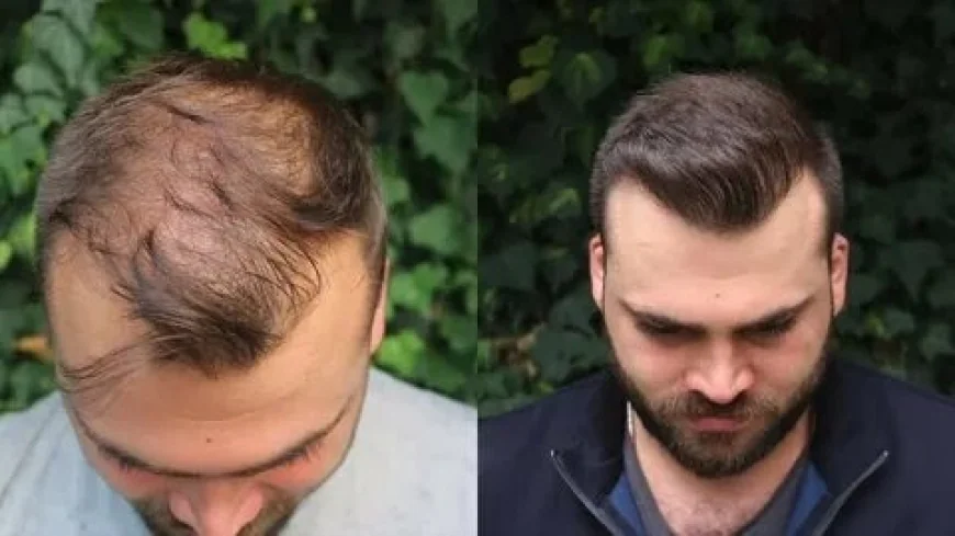 Hair Transplant for Men and Women in Islamabad