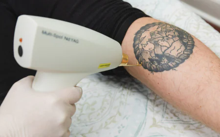How Fast Does Laser Tattoo Removal Work on Tattoos in Dubai?