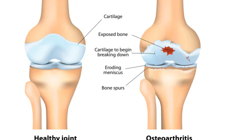 Osteoarthritis ICD 10 Code Complete Guide for Accurate Coding