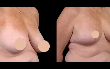 Scarless Approaches to Breast Reduction in Dubai