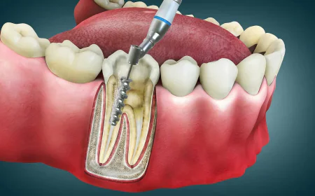 Top Clinics Offering Painless Root Canal Treatment in Delhi