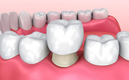 Find the Best Cosmetic Dentist for Crowns in Islamabad