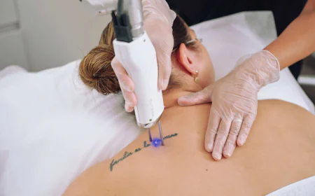 How Can Laser Tattoo Removal Boost Confidence and Skin Appearance?