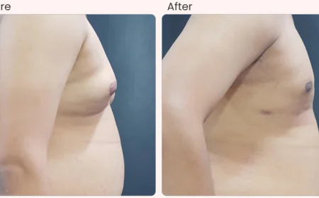 Gynecomastia Surgery Cost in Delhi - Dr Rajat Gupta