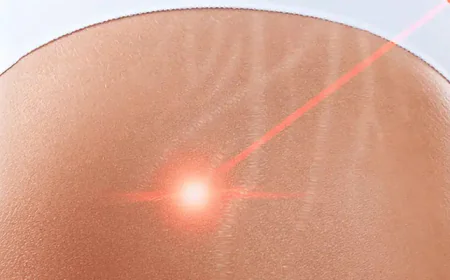 Laser Scar Removal Surgery in Dubai: Step-by-Step Guide