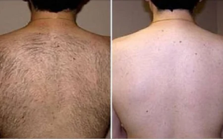 Laser hair removal in the summer: benefits and warnings you should know before the session