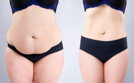 Tummy Tuck Surgery cost in Delhi - Dr Rajat Gupta