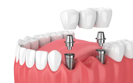Top Rated Same-Day Implant Dentists Near Me