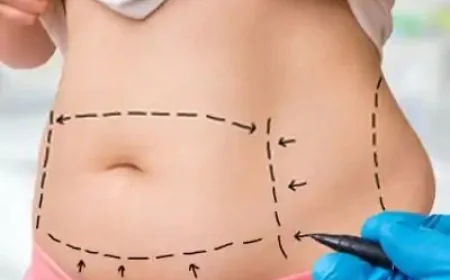 شفط الدهون من الظهر: ما الذي يمكن توقعه