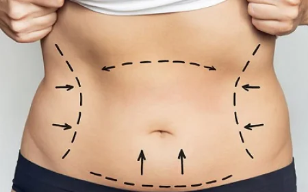 Liposuction Financing Options: Making Surgery Affordable