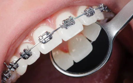 Do Braces Move Your Teeth Permanently?