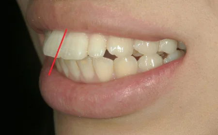 What Is the Recovery Time for Protruding Teeth Treatment?