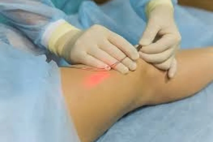 Varicose veins laser treatment cost in India Your 