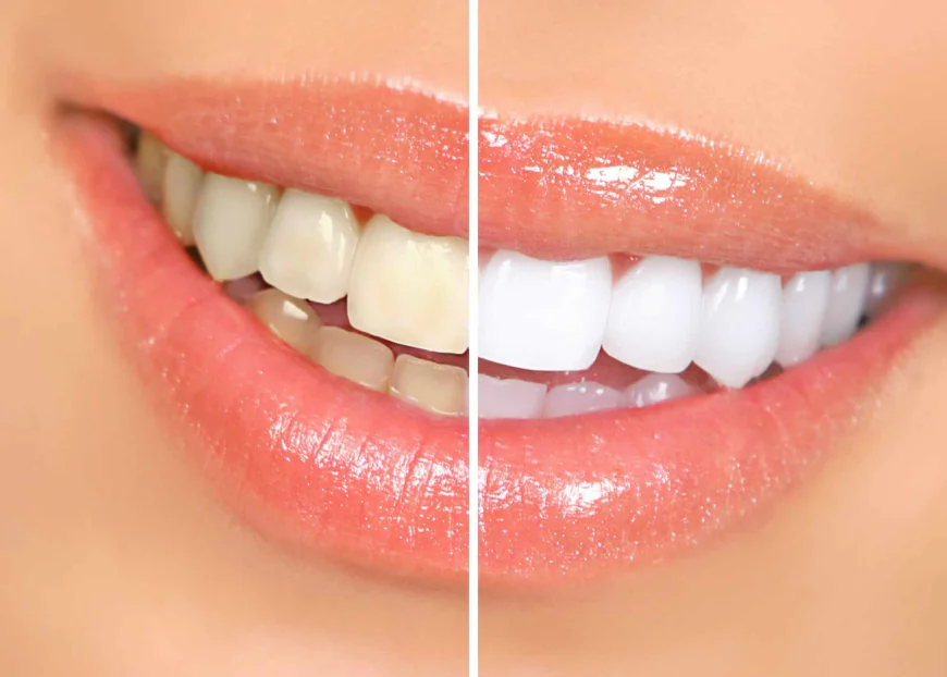 Professional Teeth Whitening: Dubai’s Trusted Clinics