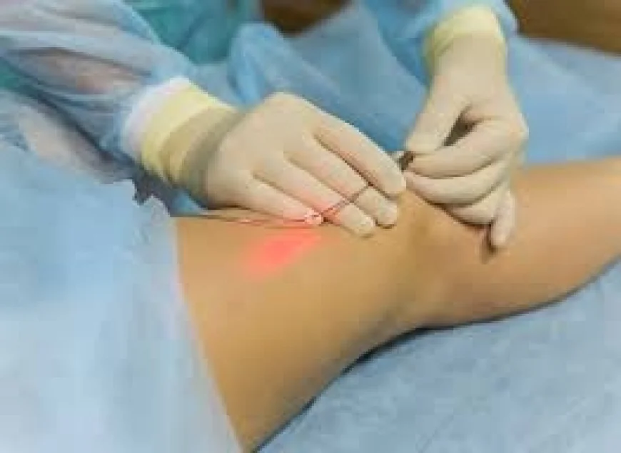 Varicose veins laser treatment cost in India Your Full Guide to the Dr. Sandeep Sharma