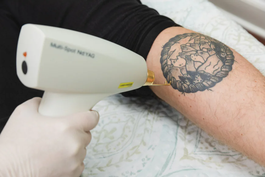 How Fast Does Laser Tattoo Removal Work on Tattoos in Dubai?