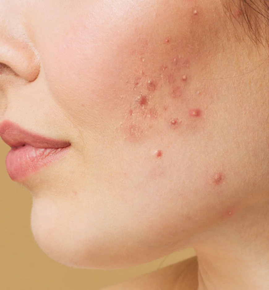 A Complete Guide to Acne Scar Removal in Dubai