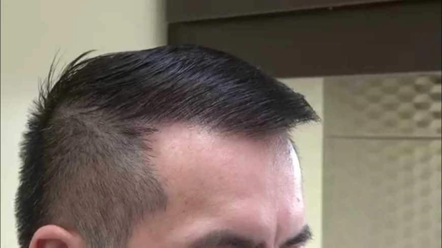 Hair Transplant in Islamabad: Combining with PRP Therapy