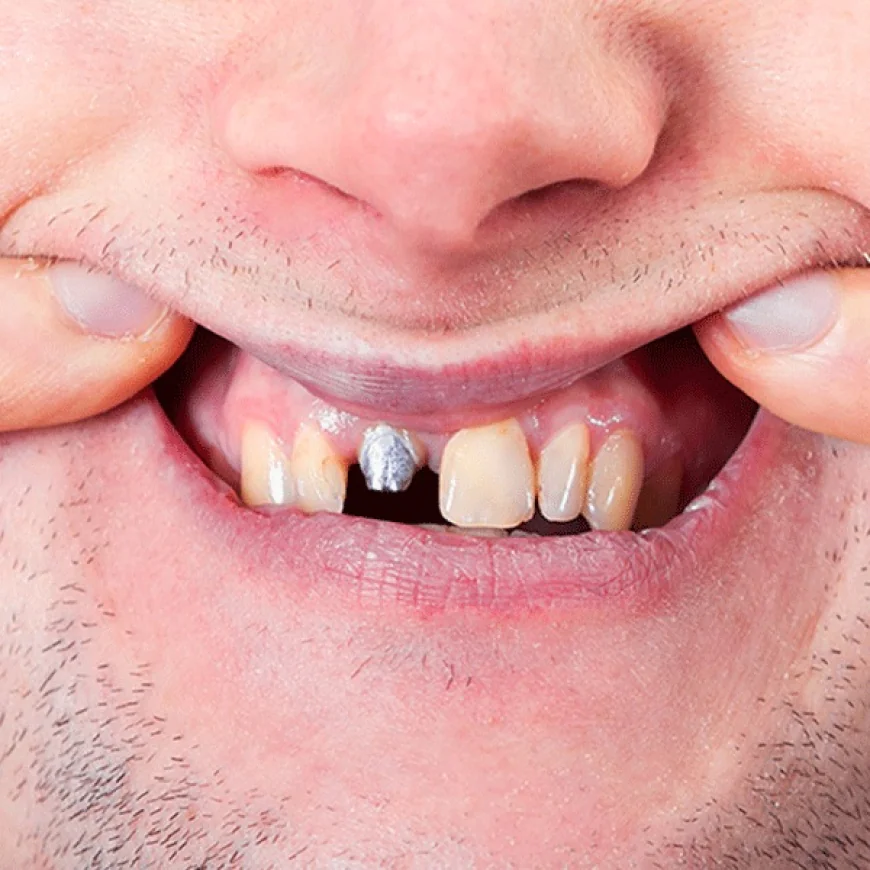 What Is the Recovery Time for the Best All-on-4 Dental Implants?