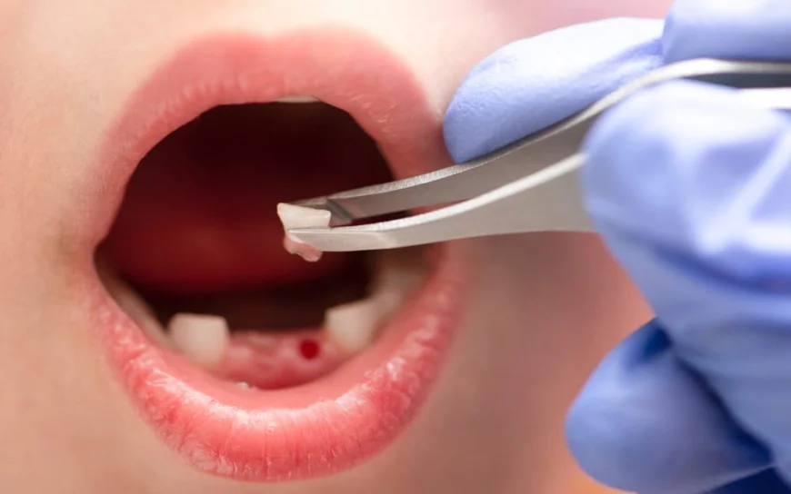 What Should I Avoid After Tooth Extraction?