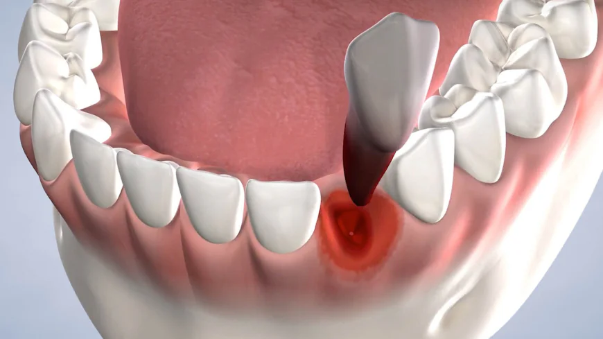 Is Tooth Extraction Cost in Dubai Expensive?