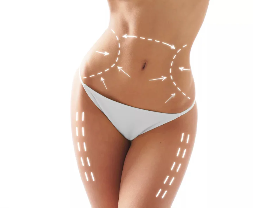 Which Liposuction Technique is Best for Men and Women in Islamabad?