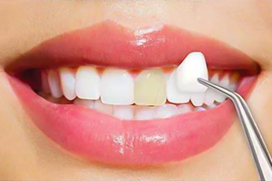 Cost of Dental Veneers in Dubai Clinics Explained