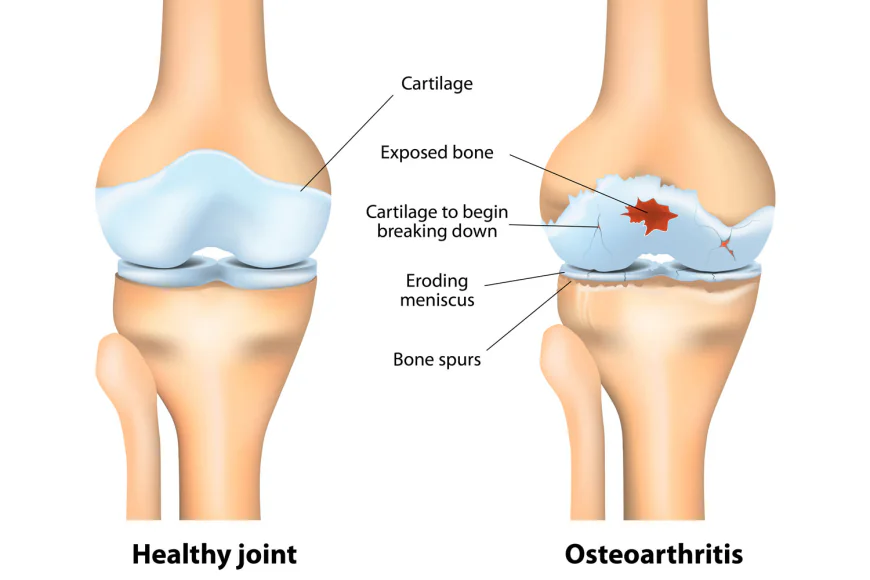 DJD ICD 10 Code Complete Guide to Degenerative Joint Disease Coding