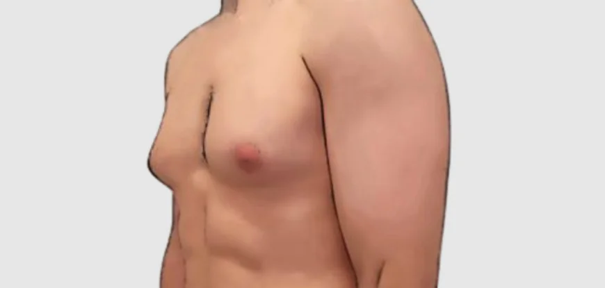Is Gynecomastia in Dubai Painful?
