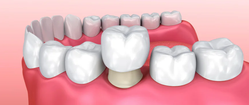 Where to Find Emergency Dental Crowns in Islamabad