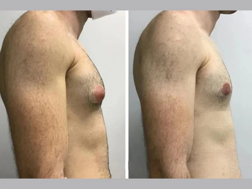 Gynecomastia Surgery in Dubai: Long-Term Chest Contouring Results